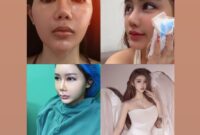 Hasil oplas BeYoung natural, elegan, dan anti gagal