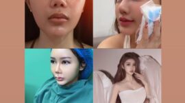 Hasil oplas BeYoung natural, elegan, dan anti gagal